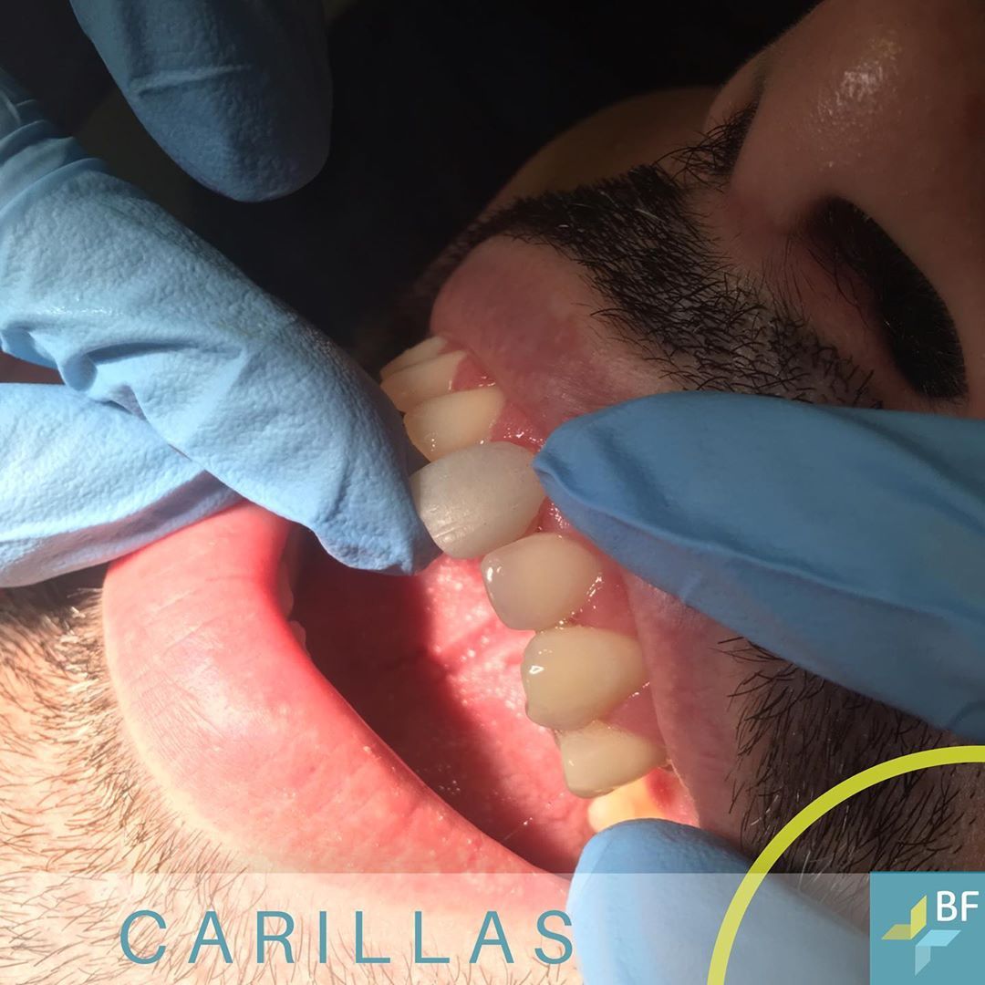 Estetica y protesis dental