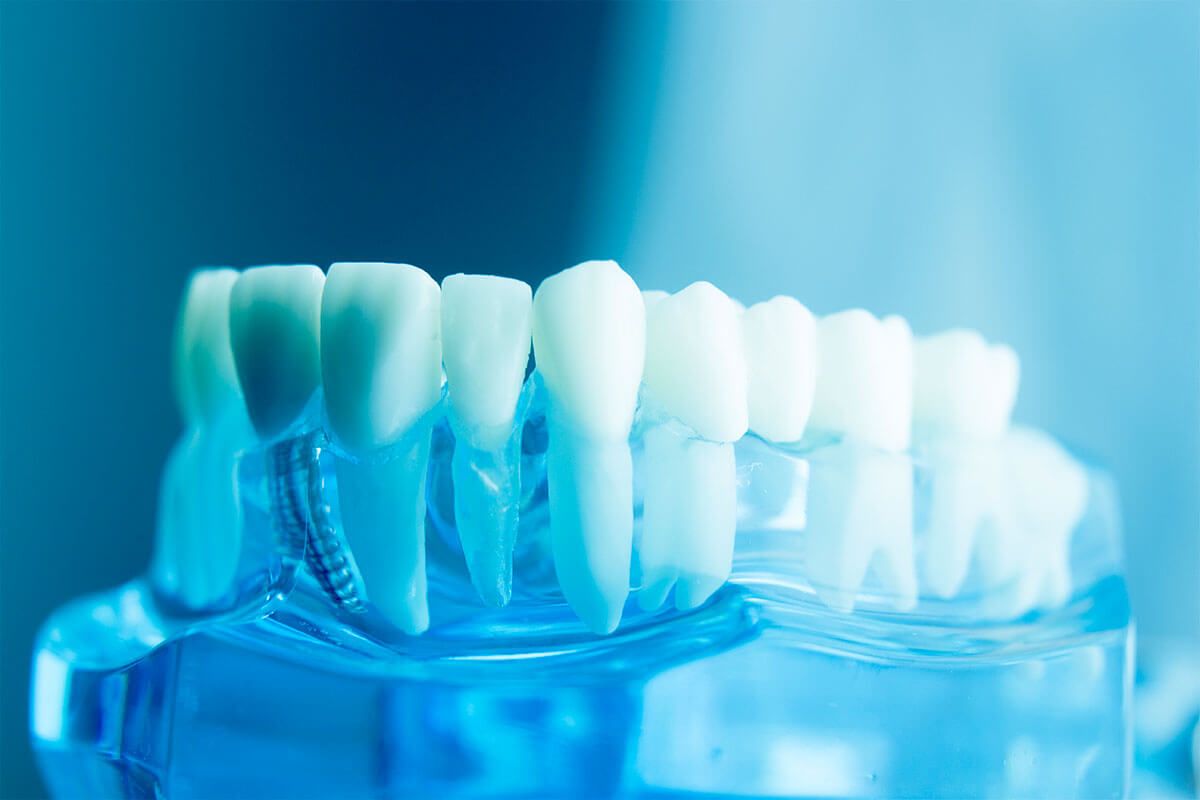 Implantes - BF Estética - interna