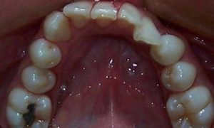 Casos_Mayerlin Bozada_MaxInf_Antes1