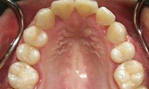 Casos_Mayerlin Bozada_MaxSup_Despues1