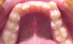 Casos_Quilen Gustavo_MaxInf_Antes1
