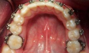Casos_Quilen Gustavo_MaxInf_Proceso1