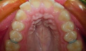 Casos_Quilen Gustavo_MaxSup_Antes1