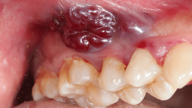 Cáncer bucal - encías - destacada - BFEsteticaDental