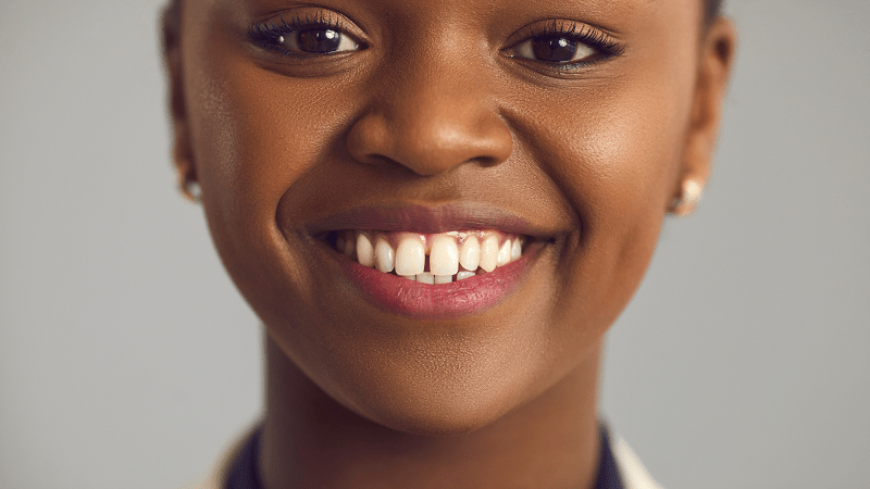 Diastemas - Espacio entre los dientes - BFEstéticaDental