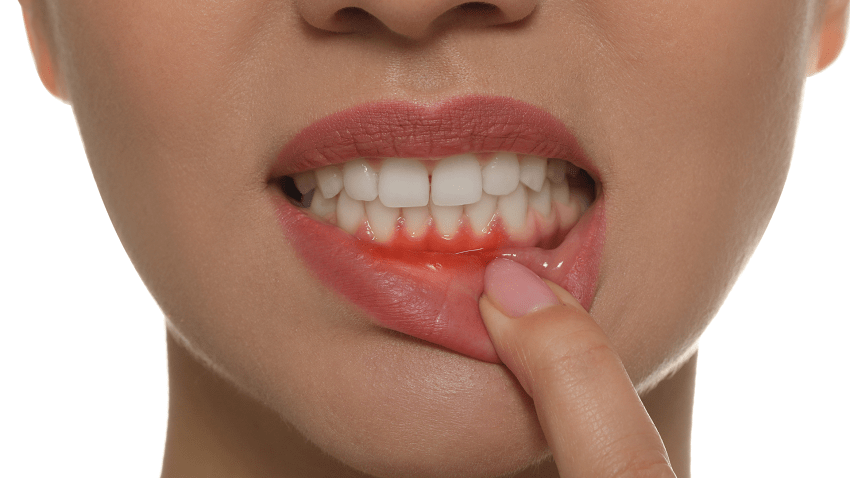 Gingivectomía y gingivoplastía - cirugía - BFEstéticaDental