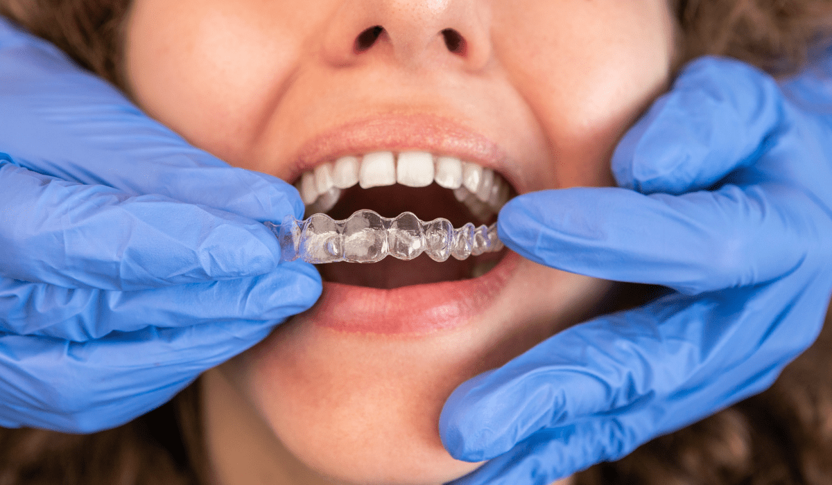 ortodoncia invisible imagen intermedia bfesteticadental