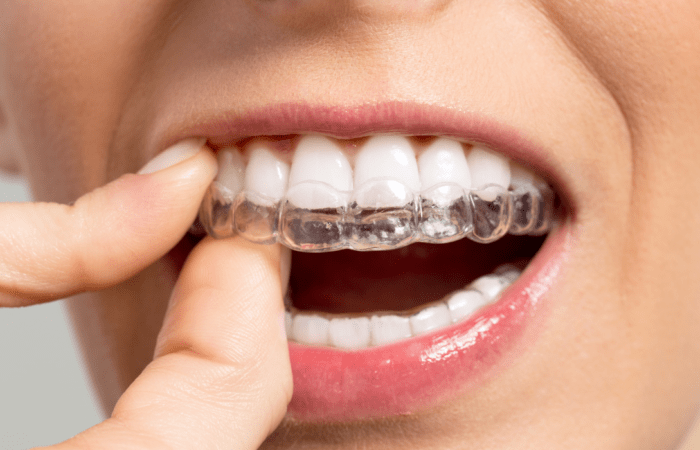 Ortondoncia invisible alineadores invisibles BDestetica Dental