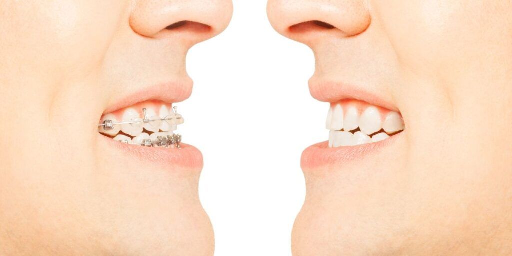 Clase I bfesteticadental imagen principal
