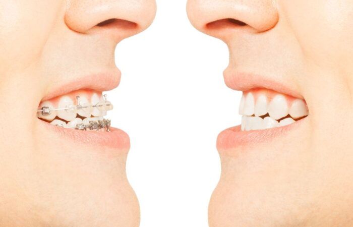 Clase I bfesteticadental imagen principal