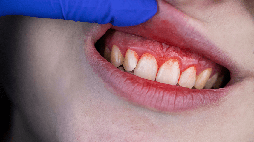 Por qué sangran las encías - sangrado - BFEstéticaDental