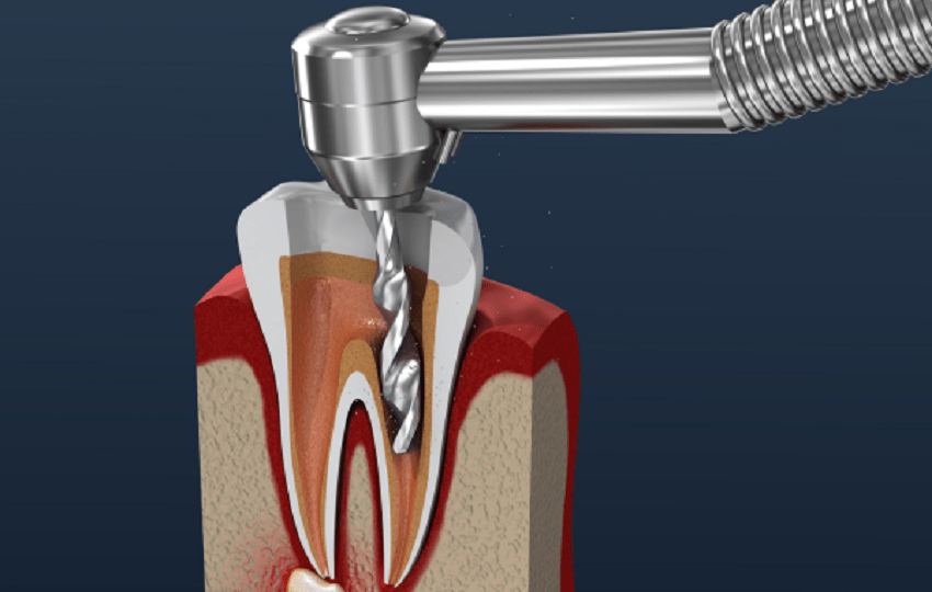 Tipos de endodoncias - proceso endodóncico - BFEstéticaDental
