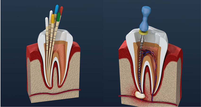 Reendodoncia - Retratamiento endodóntico - BFEstéticaDental