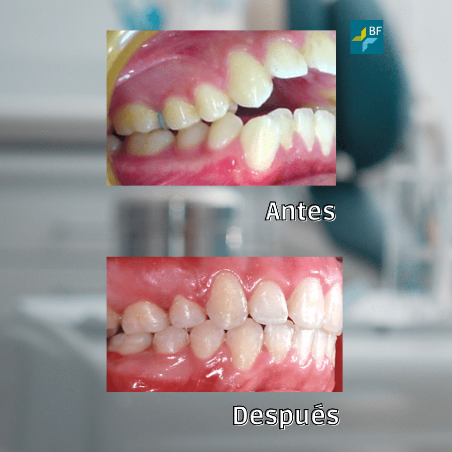 Mordida Abierta Clase II Foto 4