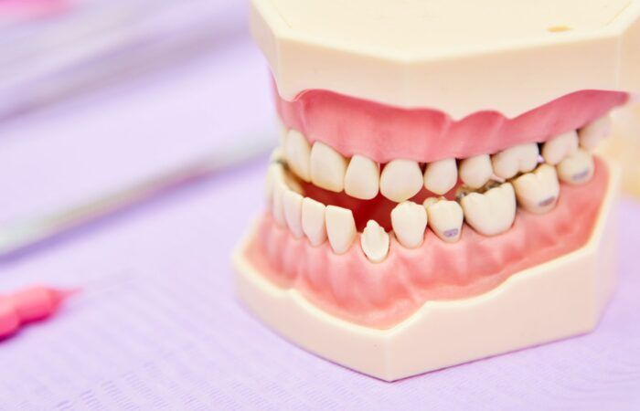 BFesteticadental clase III
