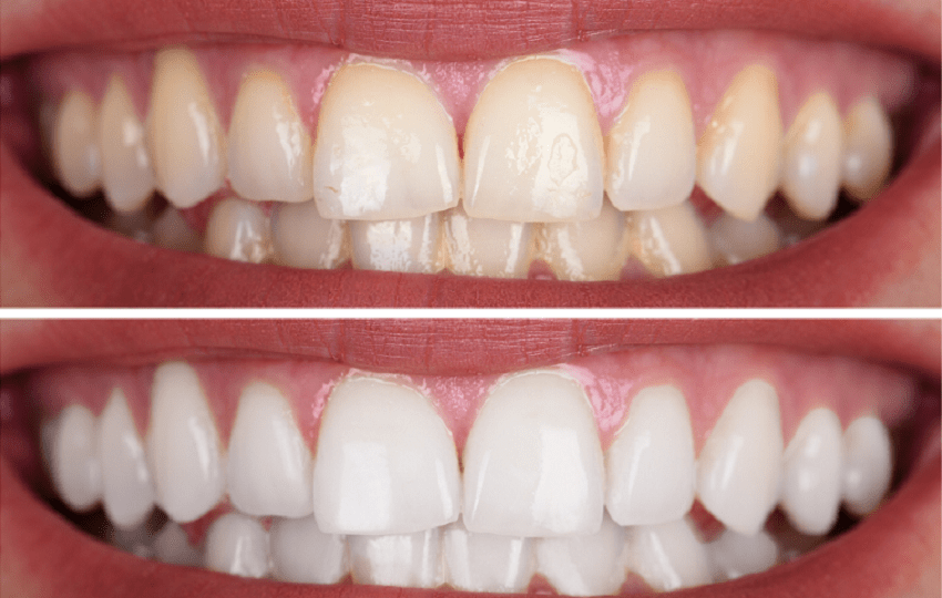 Tratamientos de blanqueamiento dental - LED y Láser - BFEstéticaDental