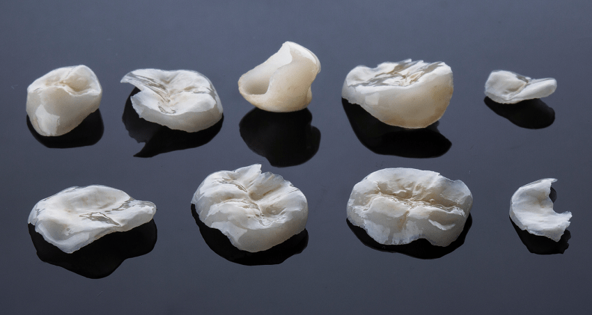 Incrustaciones dentales - Tipos - BFEstéticaDental