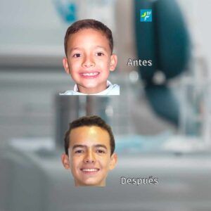 Caso 2 Ortopedia Clase II sin extracciones BF Estética Dental
