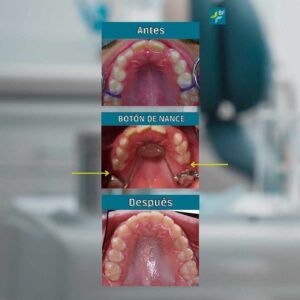 Caso 3 Ortopedia Clase II sin extracciones BF Estética Dental