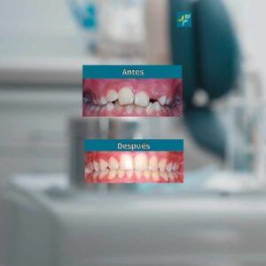 Caso 5 Ortopedia Clase II sin extracciones BF Estética Dental